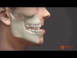 Chirurgie maxillaire